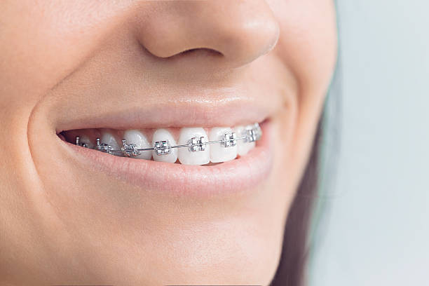 Dental Bonding in Bay City, TX